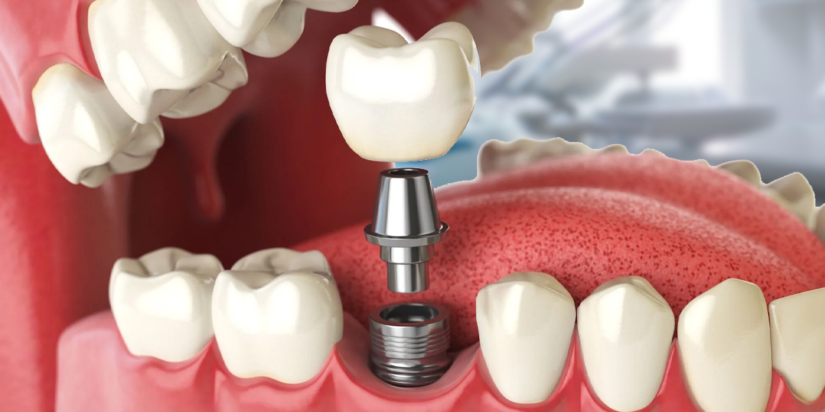 An illustration of a dental implant showing the crown, abutment, and implant post inside the jaw.